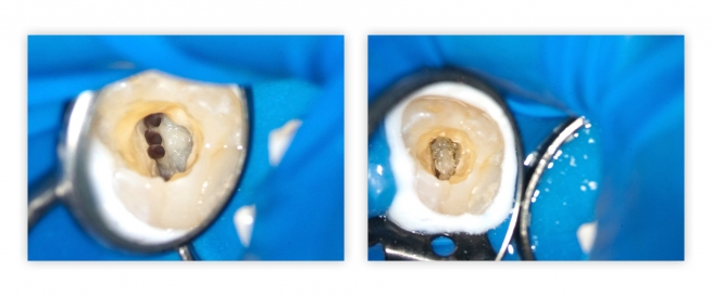 Trudne przypadki endodontyczne - dodatkowe kanały